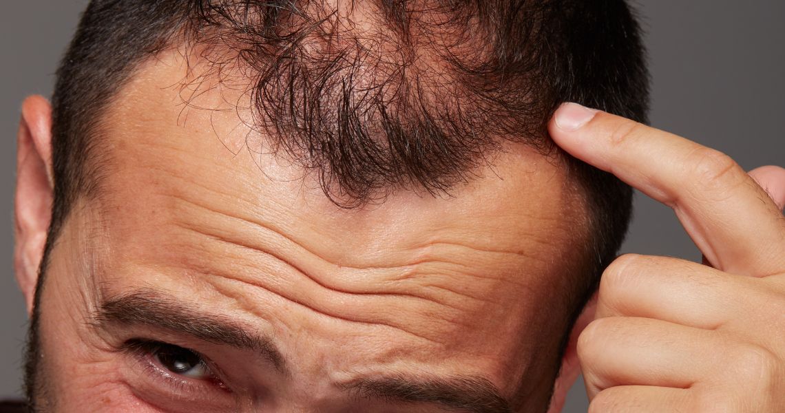 Tipos de alopecia e tratamentos